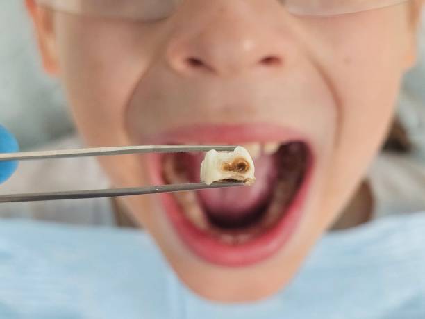 Best Knocked-Out Tooth (Avulsed Tooth) Treatment in Smoke Rise, AL